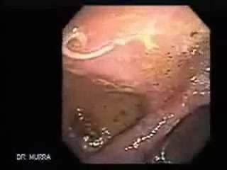 Глисты в кишечнике эндоскопия – смотреть видео онлайн в Моем Мире | NN NINA